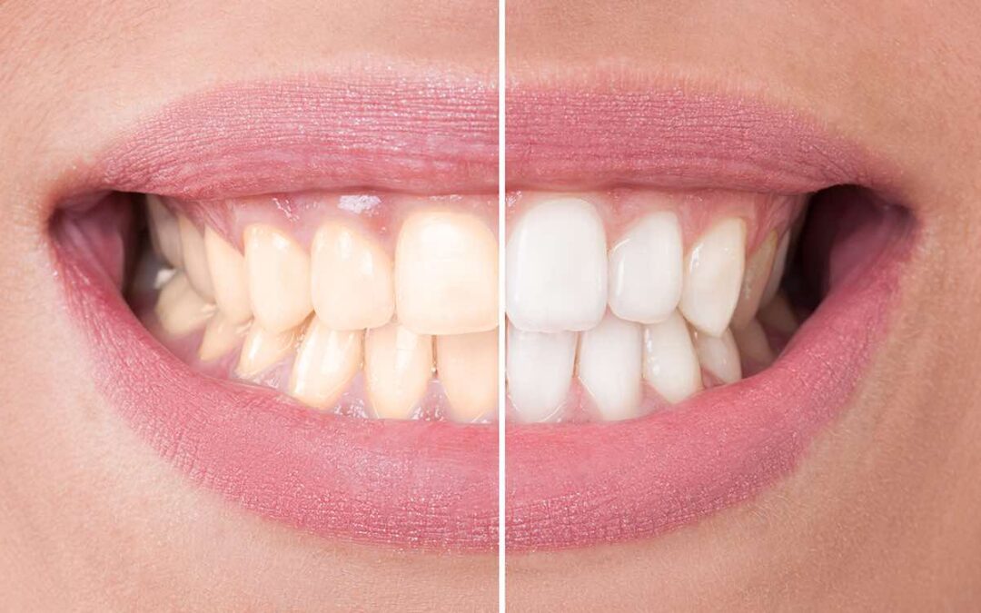 Zoom Whitening Just $199 at Lincolnwood Family Dental