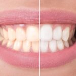 Zoom Whitening Just $199 at Lincolnwood Family Dental