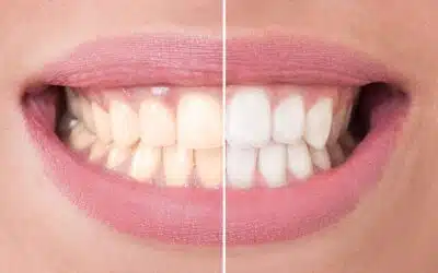 ZOOM! Whitening Special ~ $199