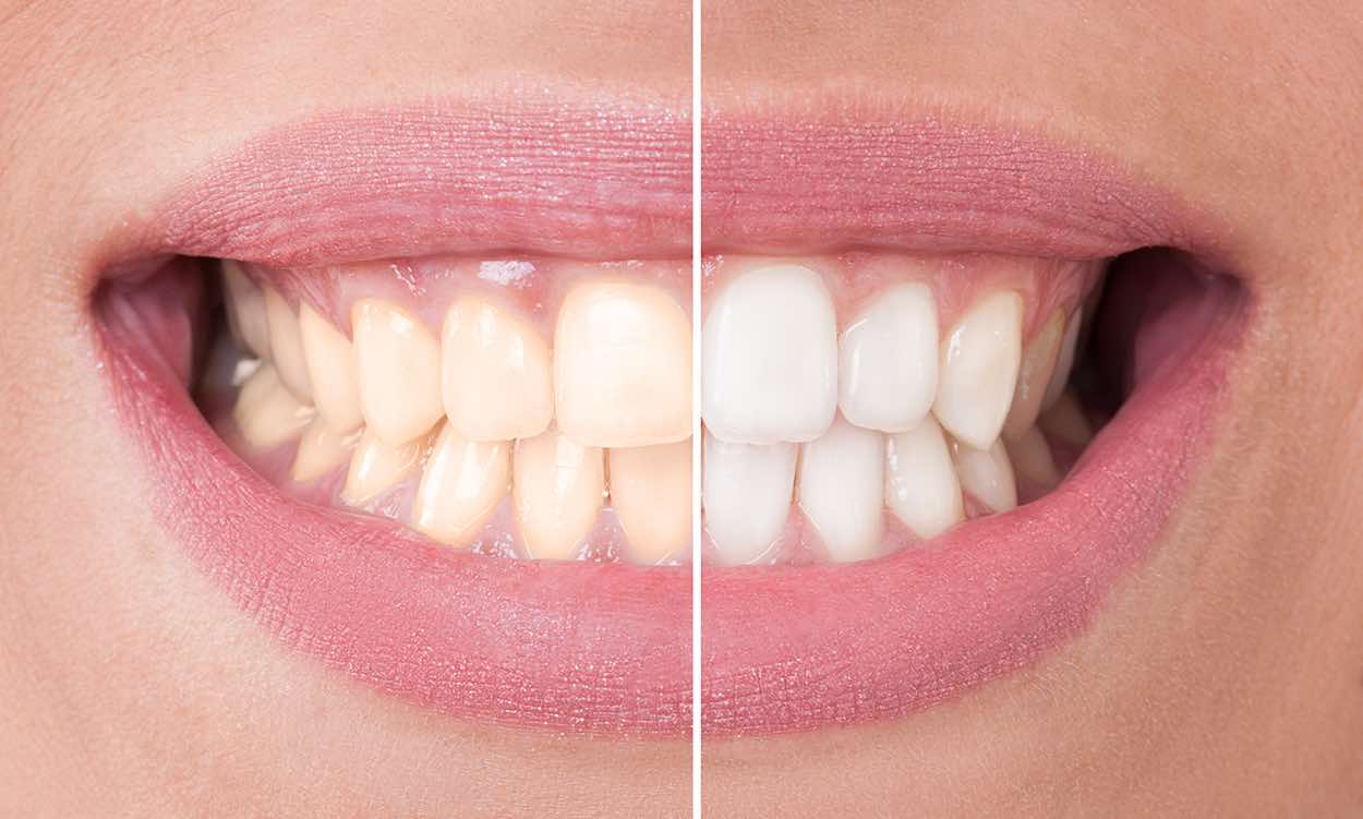 Zoom Whitening Just $199 at Lincolnwood Family Dental