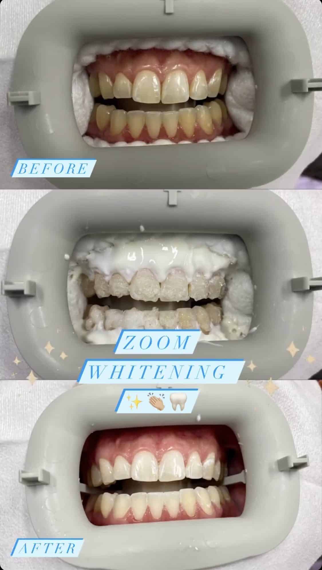 Dramatic before and after photos showcasing the stunning results of ZOOM! Teeth Whitening at Lincolnwood Family Dental.