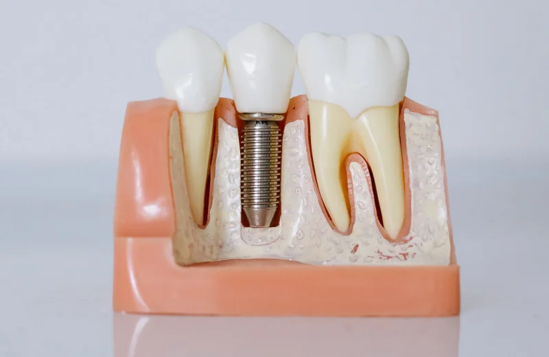 Dental-Implants