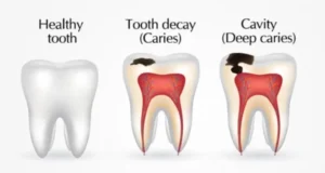 healthy-tooth