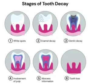 s-tooth-decay