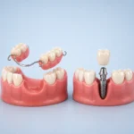 What Is a Dental Flipper and How Does It Compare to an Dental Implant