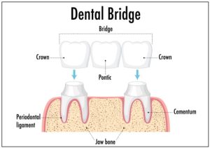 dental bridge in general dentistry