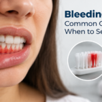 Bleeding Gums: Common Causes and When to See a Dentist