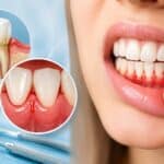 Bleeding Gums: Common Causes and When to See a Dentist