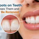 White Spots on Teeth: What Causes Them and Can They Be Removed?
