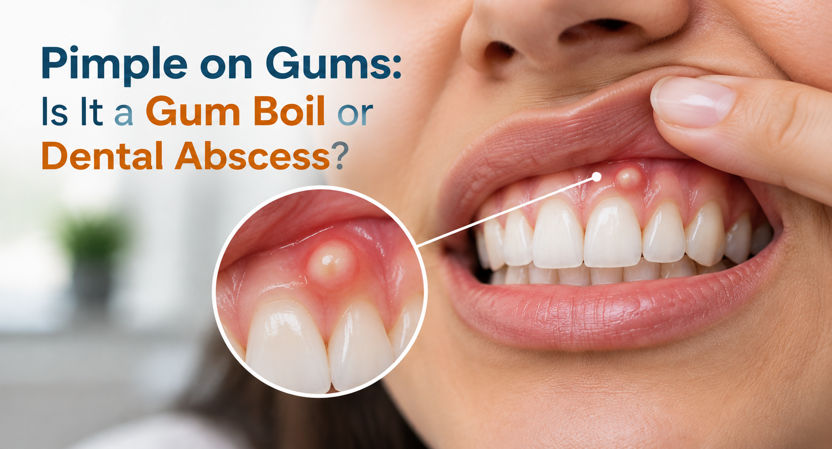 Pimple on Gums: Is It a Gum Boil or Dental Abscess?