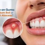 Pimple on Gums: Is It a Gum Boil or Dental Abscess?