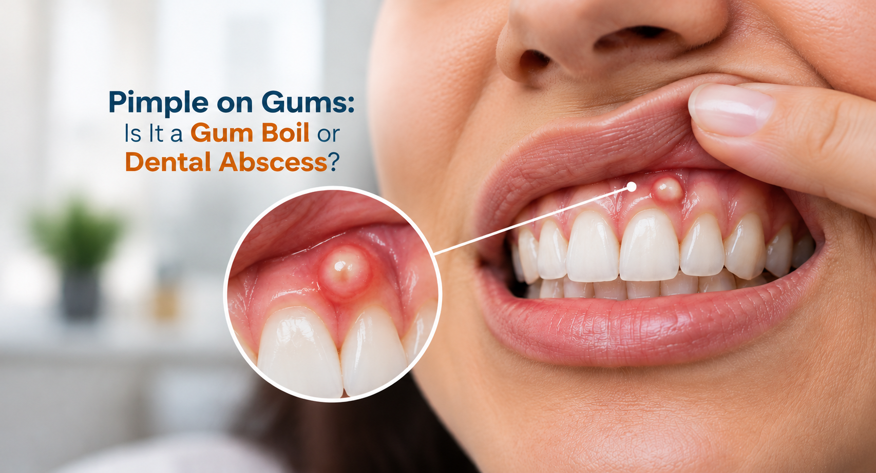 Pimple on Gums: Is It a Gum Boil or Dental Abscess?