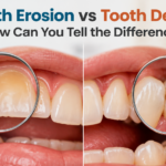 Tooth Erosion vs Tooth Decay