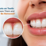 White Spots on Teeth