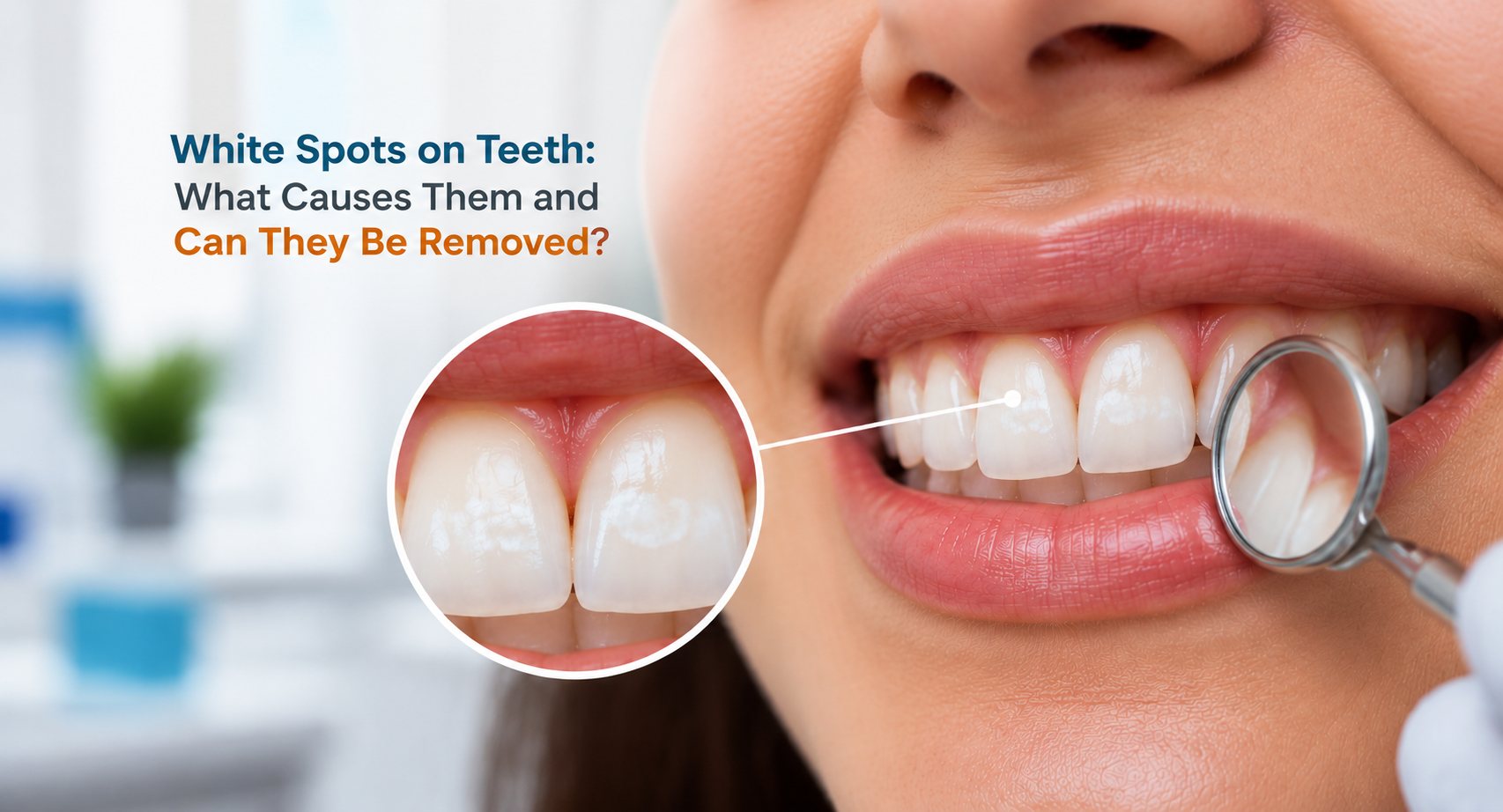 White Spots on Teeth