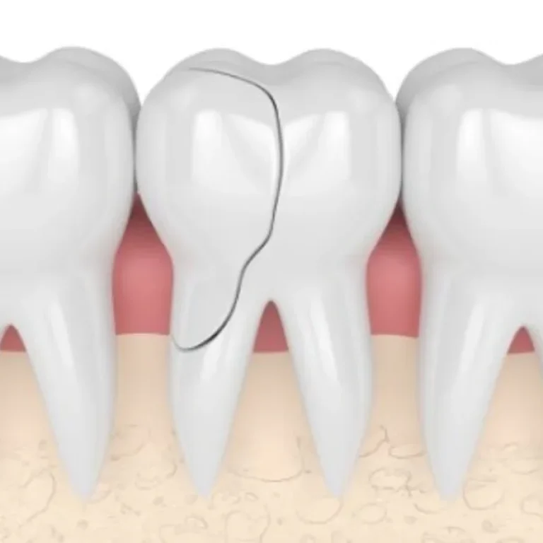 cracked tooth featured