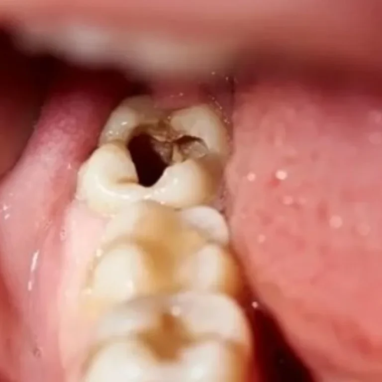 decay-tooth
