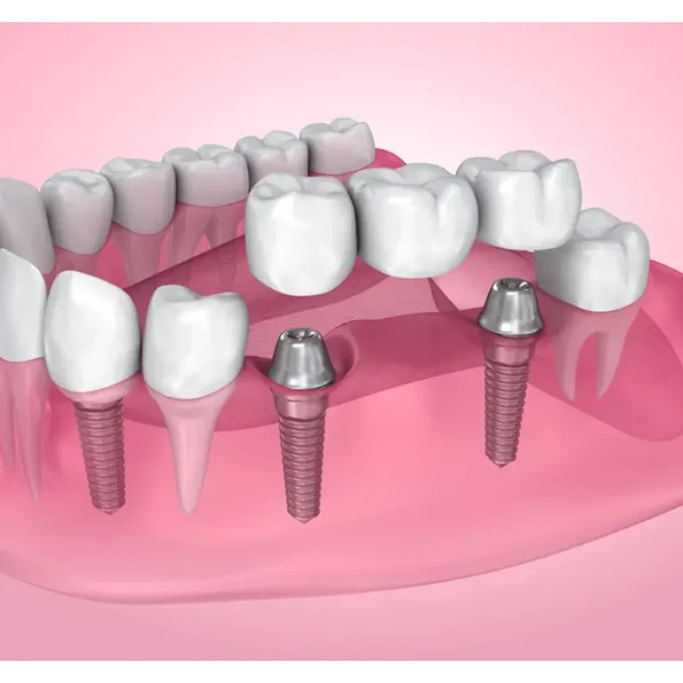 dental bridge-