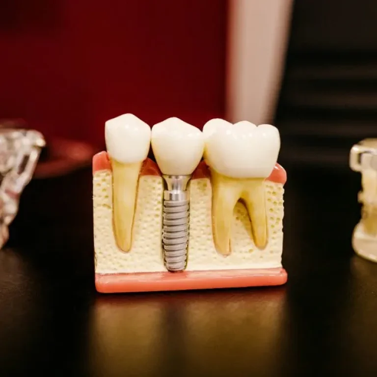 dental implant feature