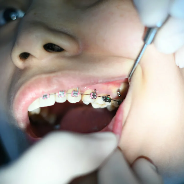 tooth bonding