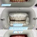 Dramatic before and after photos showcasing the stunning results of ZOOM! Teeth Whitening at Lincolnwood Family Dental.