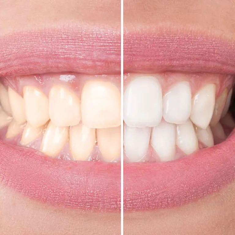 Zoom Whitening Just $199 at Lincolnwood Family Dental